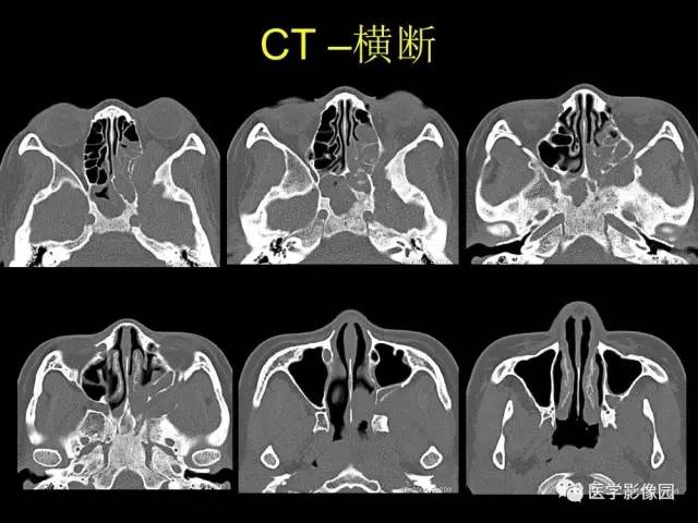 【PPT】头颈部恶性肿瘤影像诊断 重视颅底神经孔道改变