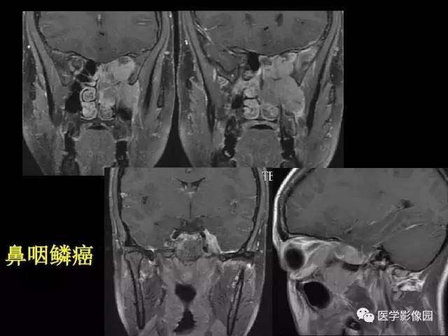 【PPT】头颈部恶性肿瘤影像诊断 重视颅底神经孔道改变