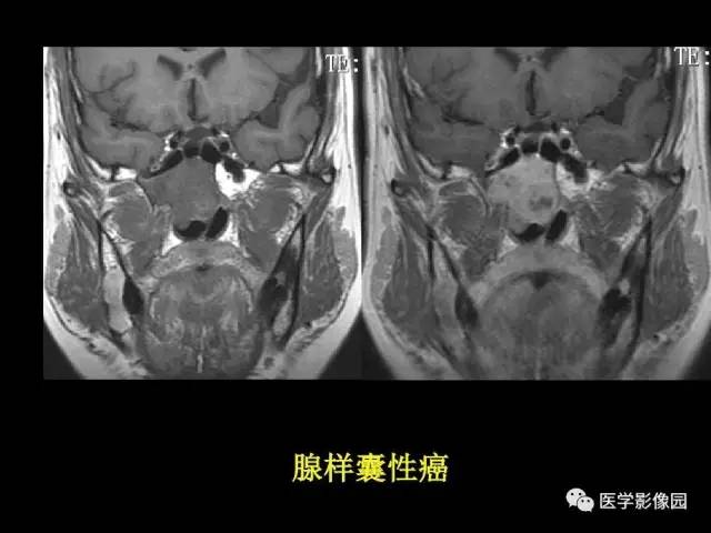 【PPT】头颈部恶性肿瘤影像诊断 重视颅底神经孔道改变