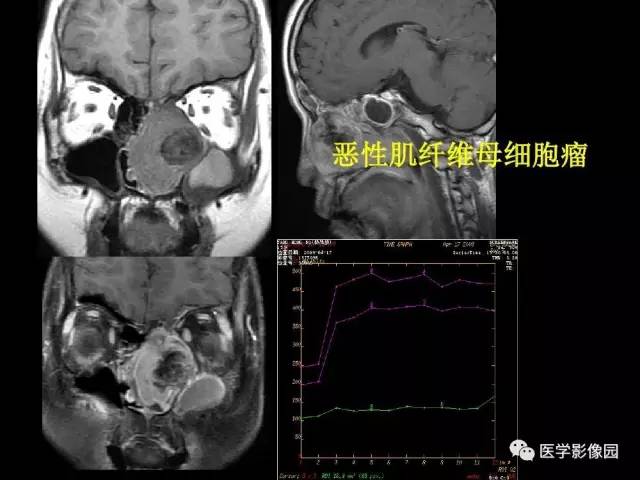 【PPT】头颈部恶性肿瘤影像诊断 重视颅底神经孔道改变