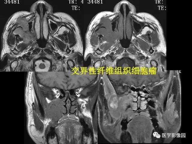【PPT】头颈部恶性肿瘤影像诊断 重视颅底神经孔道改变