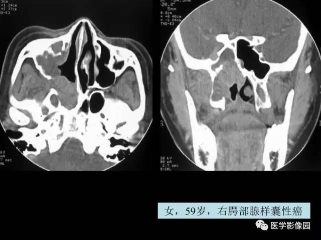 【PPT】头颈部恶性肿瘤影像诊断 重视颅底神经孔道改变