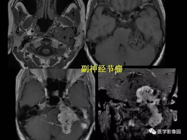 【PPT】头颈部恶性肿瘤影像诊断 重视颅底神经孔道改变