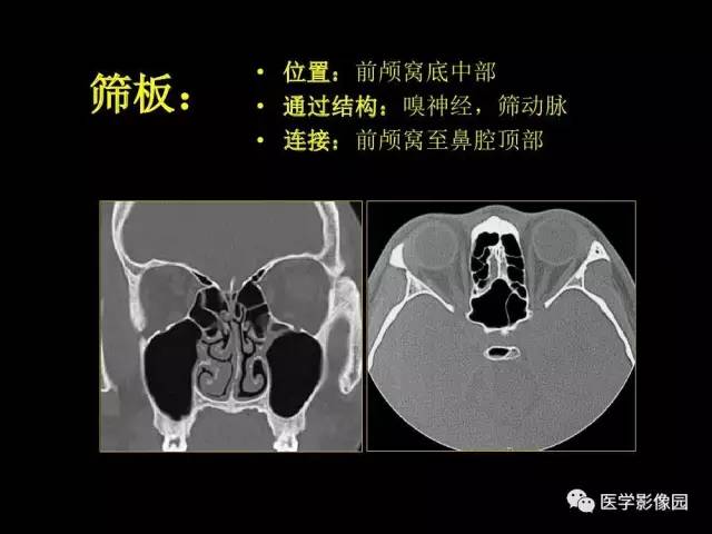 【PPT】头颈部恶性肿瘤影像诊断 重视颅底神经孔道改变