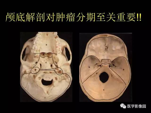 【PPT】头颈部恶性肿瘤影像诊断 重视颅底神经孔道改变
