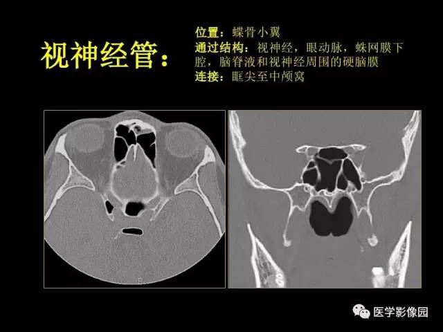 【PPT】头颈部恶性肿瘤影像诊断 重视颅底神经孔道改变
