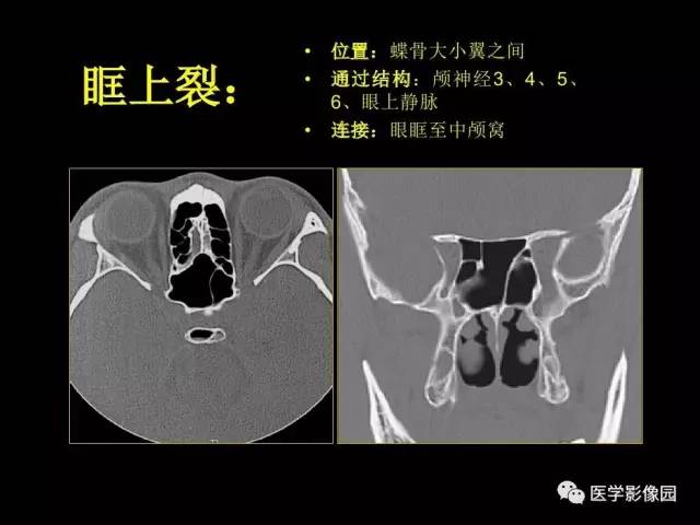 【PPT】头颈部恶性肿瘤影像诊断 重视颅底神经孔道改变