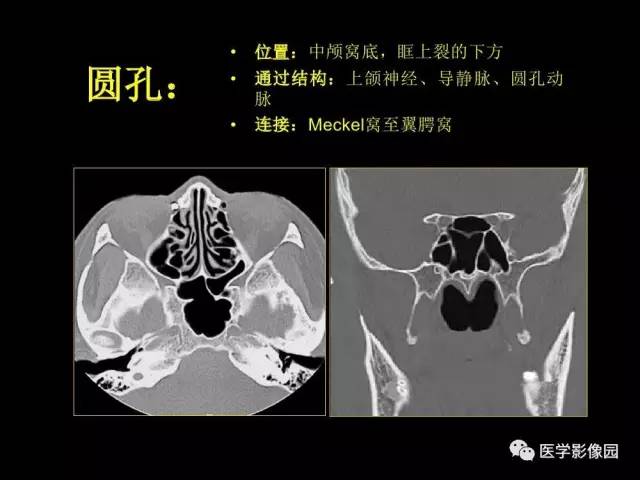 【PPT】头颈部恶性肿瘤影像诊断 重视颅底神经孔道改变