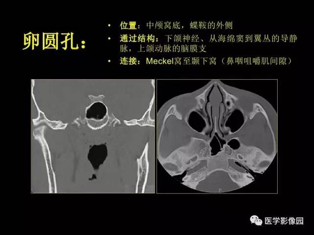 【PPT】头颈部恶性肿瘤影像诊断 重视颅底神经孔道改变