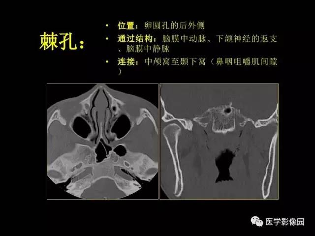 【PPT】头颈部恶性肿瘤影像诊断 重视颅底神经孔道改变
