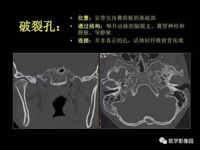 【PPT】头颈部恶性肿瘤影像诊断 重视颅底神经孔道改变
