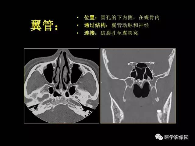 【PPT】头颈部恶性肿瘤影像诊断 重视颅底神经孔道改变