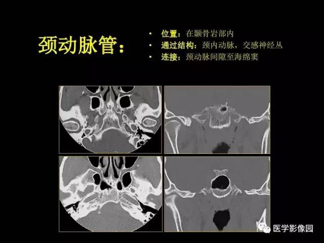 【PPT】头颈部恶性肿瘤影像诊断 重视颅底神经孔道改变