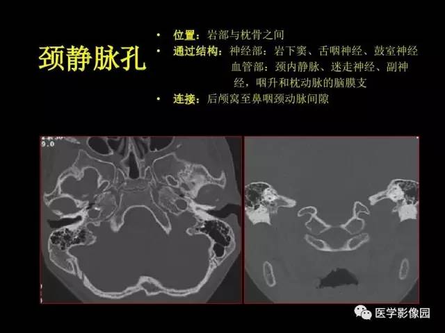 【PPT】头颈部恶性肿瘤影像诊断 重视颅底神经孔道改变