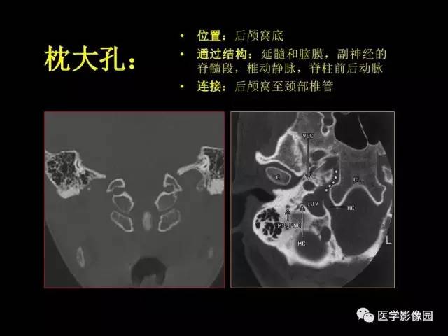 【PPT】头颈部恶性肿瘤影像诊断 重视颅底神经孔道改变