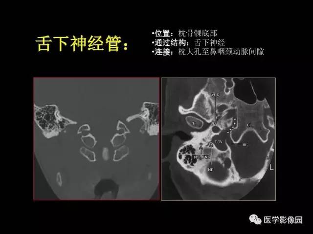 【PPT】头颈部恶性肿瘤影像诊断 重视颅底神经孔道改变