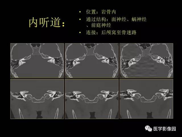 【PPT】头颈部恶性肿瘤影像诊断 重视颅底神经孔道改变