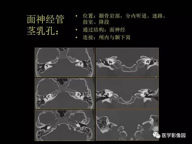 【PPT】头颈部恶性肿瘤影像诊断 重视颅底神经孔道改变