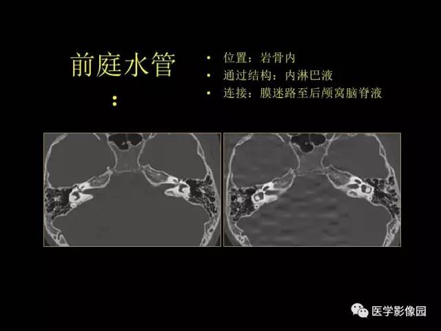 【PPT】头颈部恶性肿瘤影像诊断 重视颅底神经孔道改变