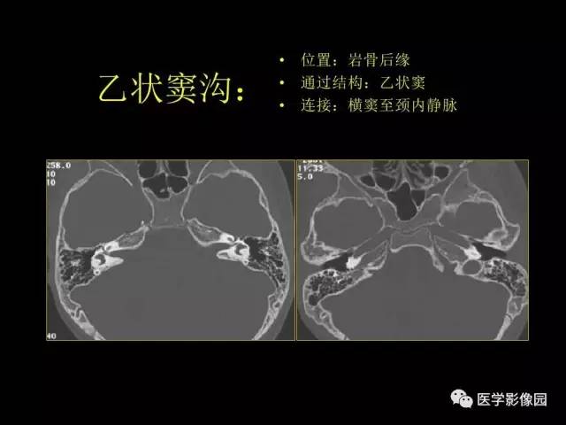 【PPT】头颈部恶性肿瘤影像诊断 重视颅底神经孔道改变