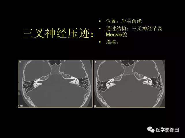 【PPT】头颈部恶性肿瘤影像诊断 重视颅底神经孔道改变