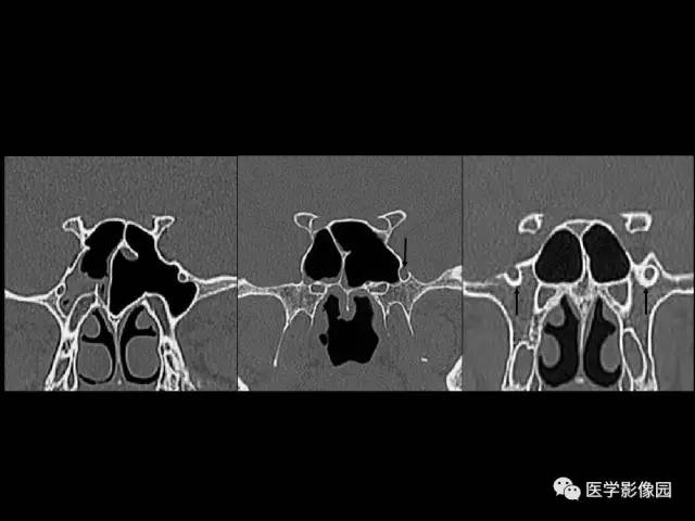 【PPT】头颈部恶性肿瘤影像诊断 重视颅底神经孔道改变