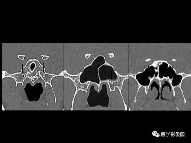 【PPT】头颈部恶性肿瘤影像诊断 重视颅底神经孔道改变
