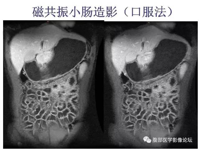 【PPT】磁共振成像小肠造影