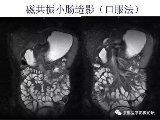 【PPT】磁共振成像小肠造影
