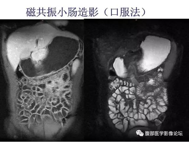 【PPT】磁共振成像小肠造影