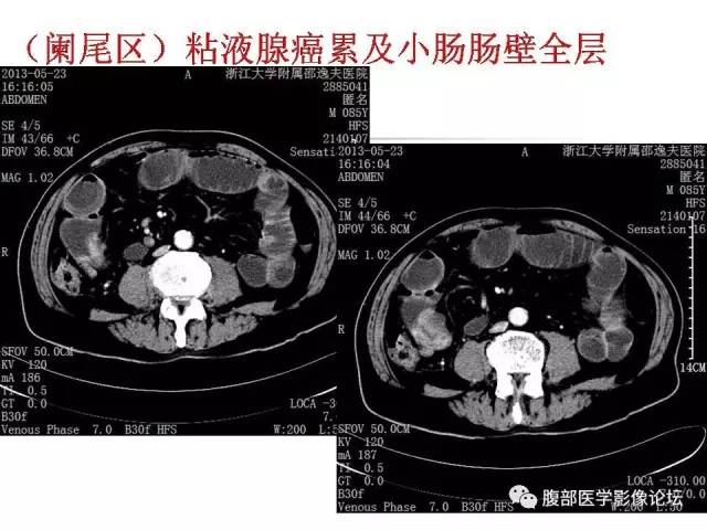 【PPT】磁共振成像小肠造影