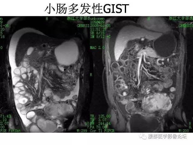 【PPT】磁共振成像小肠造影