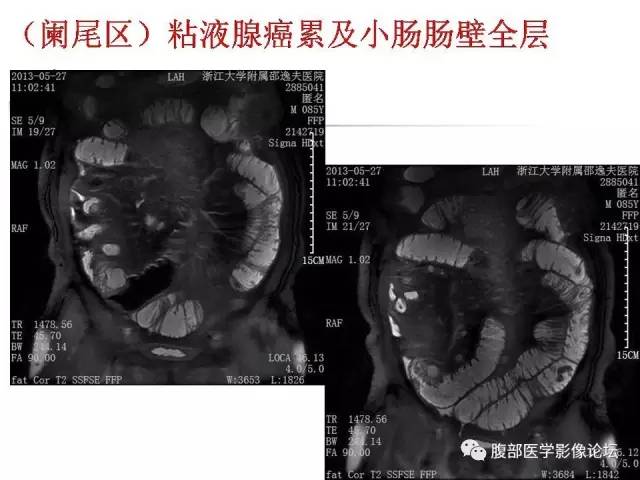 【PPT】磁共振成像小肠造影