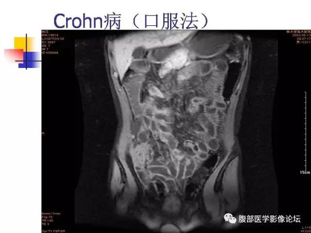 【PPT】磁共振成像小肠造影