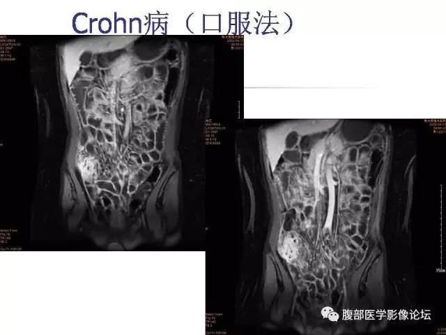 【PPT】磁共振成像小肠造影