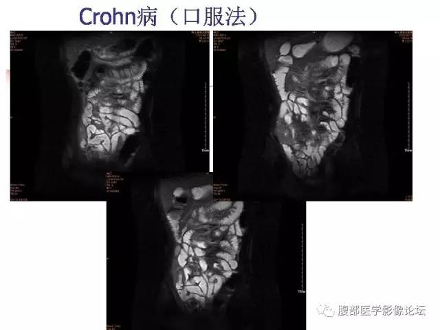 【PPT】磁共振成像小肠造影