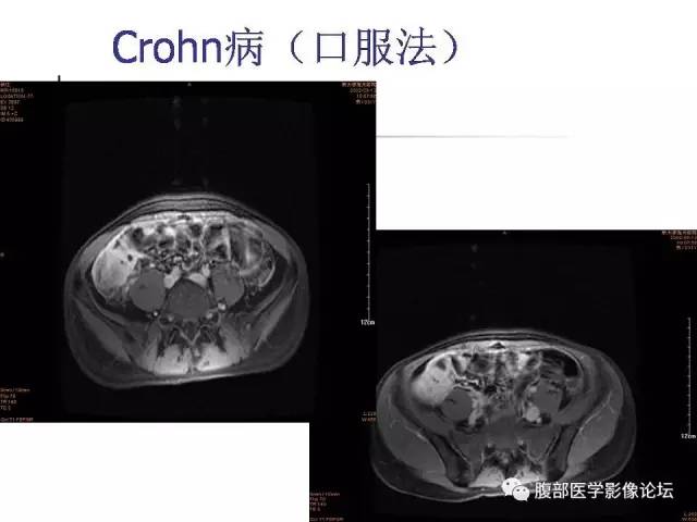 【PPT】磁共振成像小肠造影