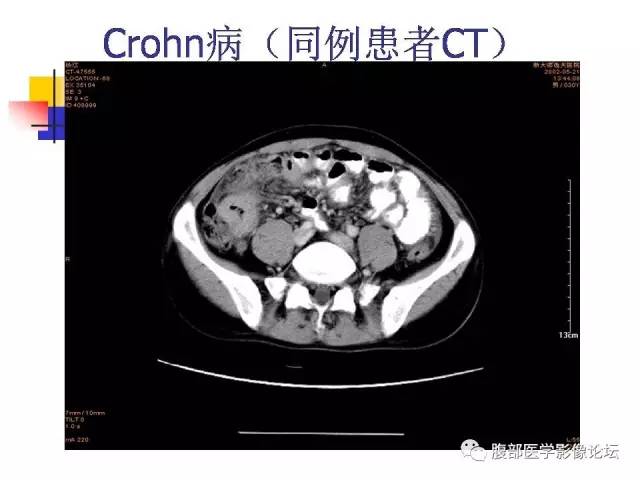【PPT】磁共振成像小肠造影