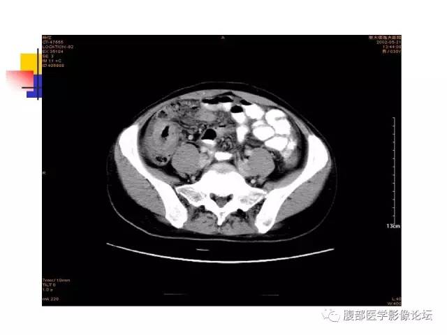 【PPT】磁共振成像小肠造影