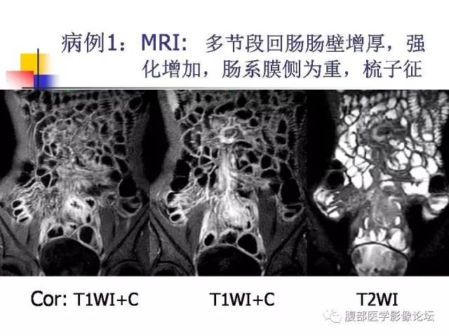 【PPT】磁共振成像小肠造影