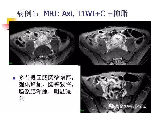 【PPT】磁共振成像小肠造影