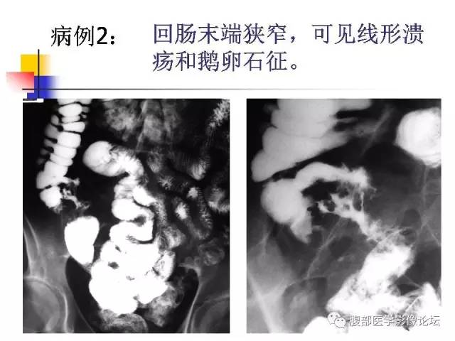 【PPT】磁共振成像小肠造影