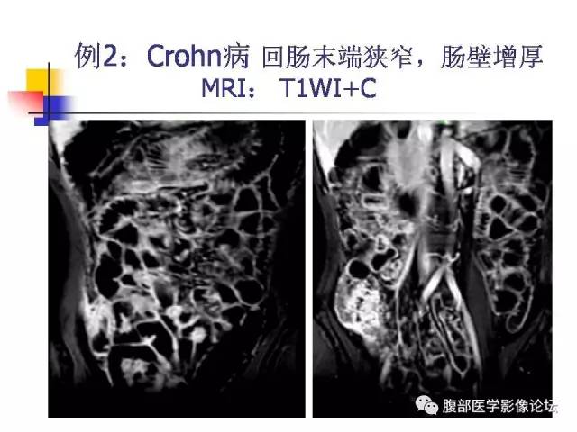 【PPT】磁共振成像小肠造影