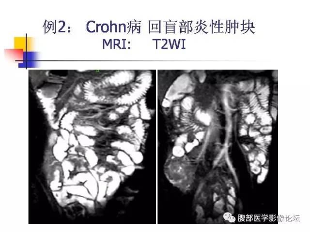 【PPT】磁共振成像小肠造影