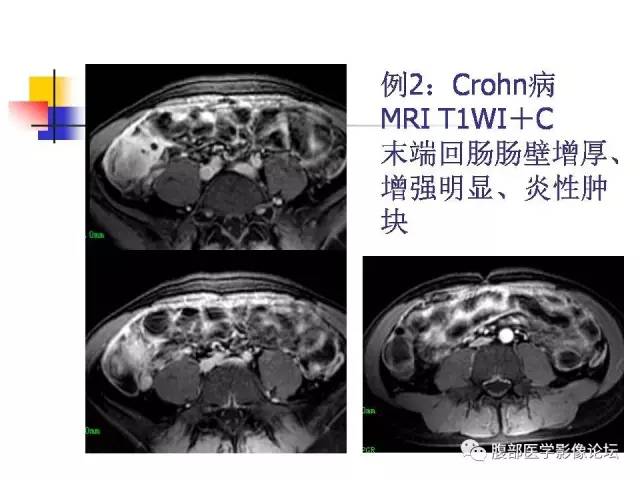 【PPT】磁共振成像小肠造影