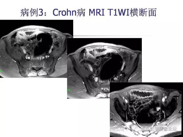 【PPT】磁共振成像小肠造影
