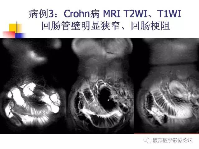 【PPT】磁共振成像小肠造影