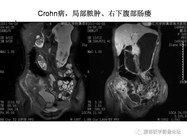 【PPT】磁共振成像小肠造影