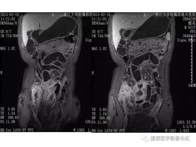 【PPT】磁共振成像小肠造影