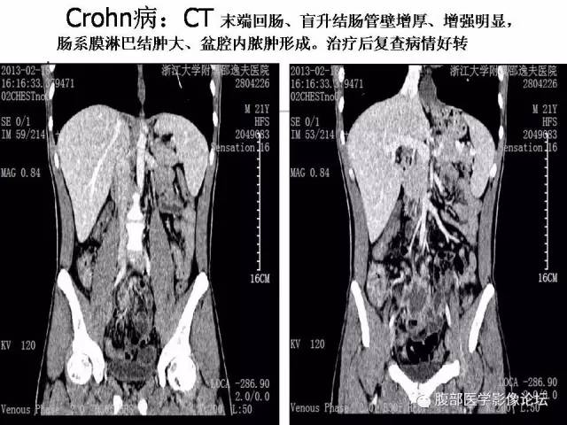 【PPT】磁共振成像小肠造影